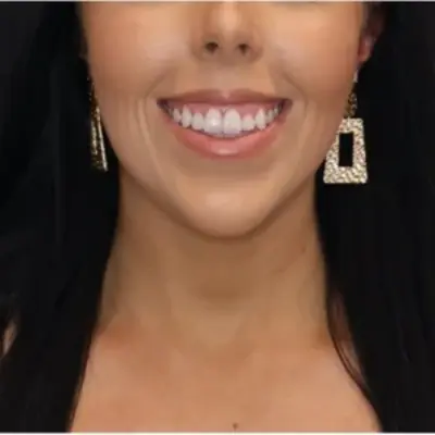 lip flip before and after smile