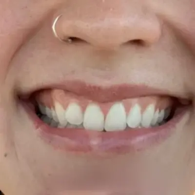 lip flip before and after smile