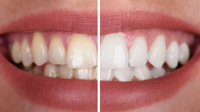 before and after teeth whitening pen image