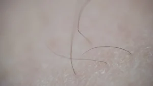 female body laser pubic hair removal before and after pictures