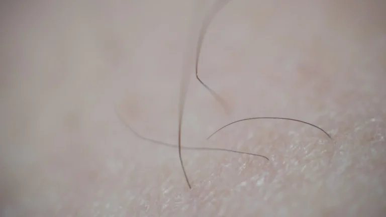 female body laser pubic hair removal before and after pictures