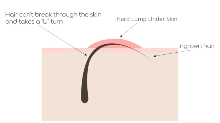 ingrown hair turned into hard lump under skin