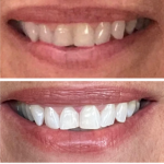 before and after teeth whitening pen customer review image