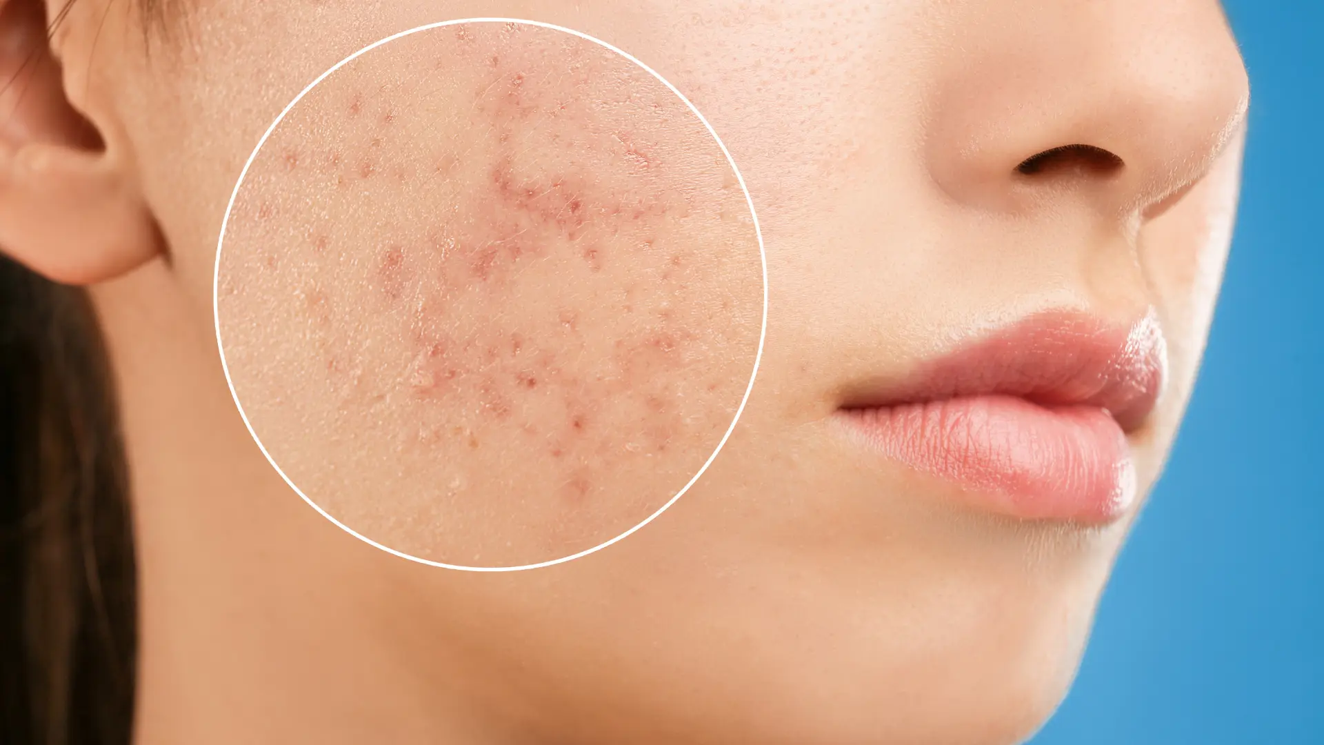 How To Treat Dry Acne-Prone Skin In The Winter