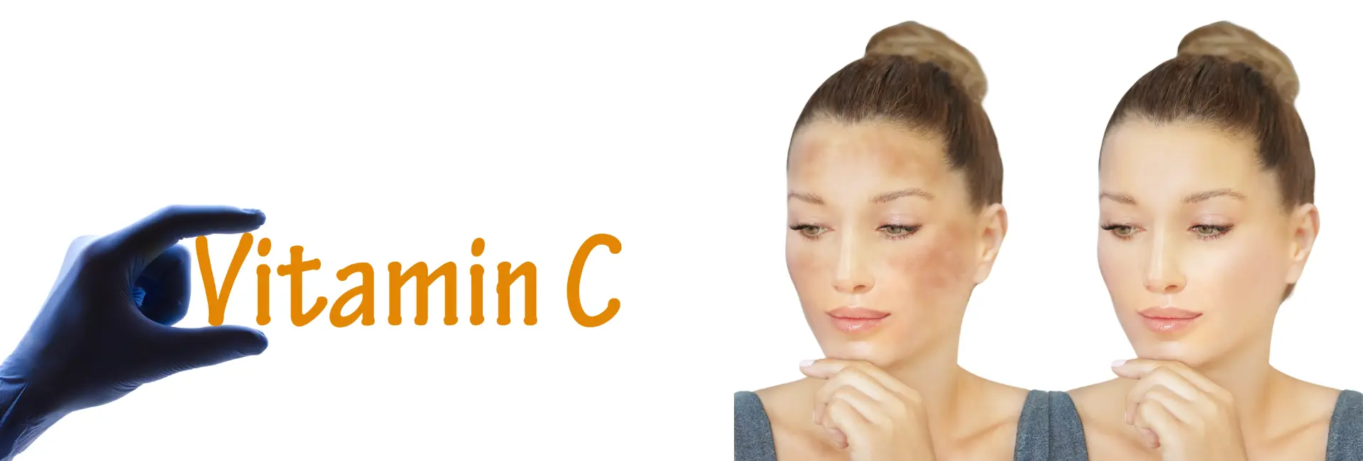 Vitamin C for Hyperpigmentation